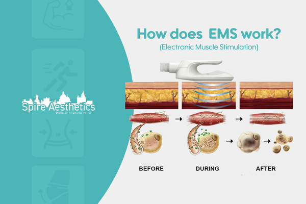 EMS treatment for post pregnancy weight loss treatment Great Missenden