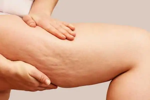 Image of woman showing leg with cellulite Great Missenden