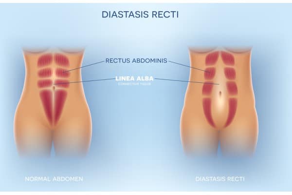 What Non-Surgical Options Are Available for Diastasis Recti Great Missenden?