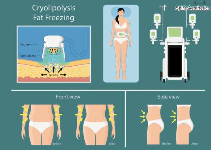 Image of diet and fat freezing combined for best results for Spire Aesthetics Great Missenden