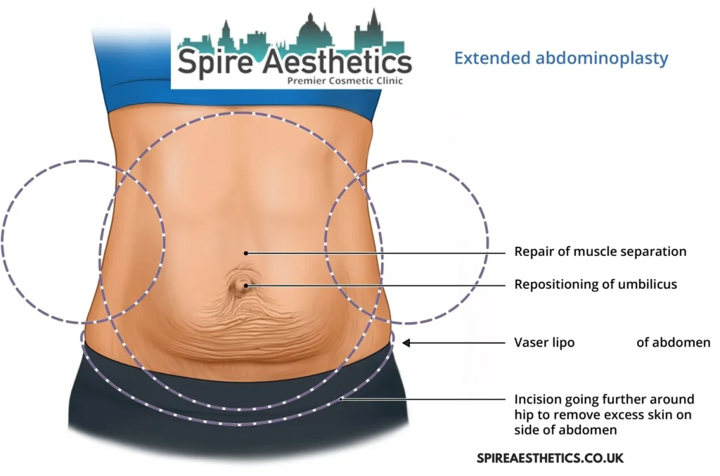 Understanding Loose Skin After Gastric Band Great Missenden Surgery and HIFU Treatment