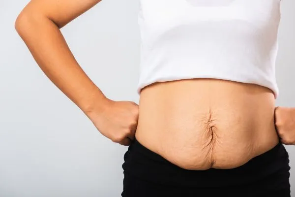 Image of a woman's stomach after weight loss with sagging skin following a gastric band Great Missenden