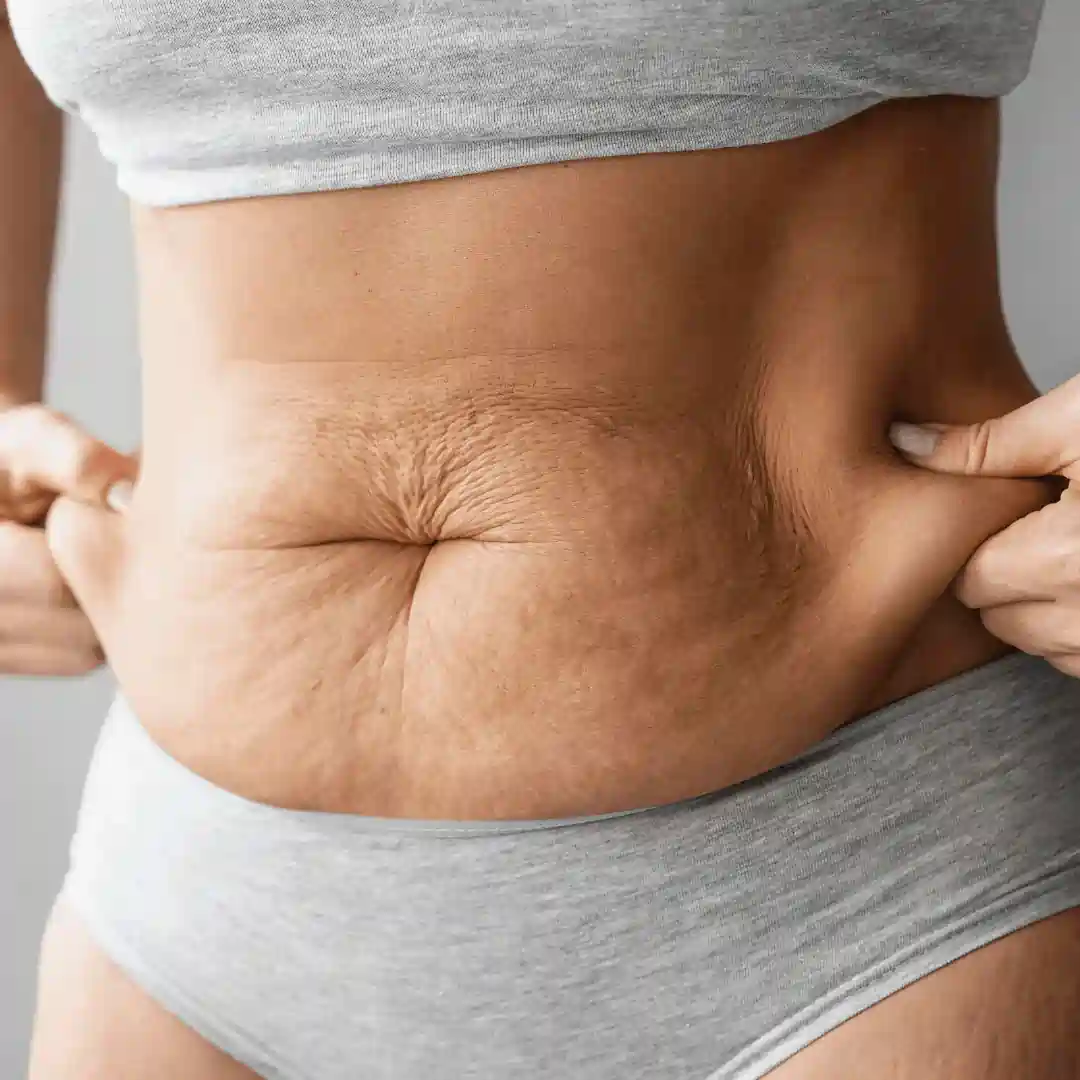 Is It Normal to Have Loose Skin After Pregnancy Great Missenden?