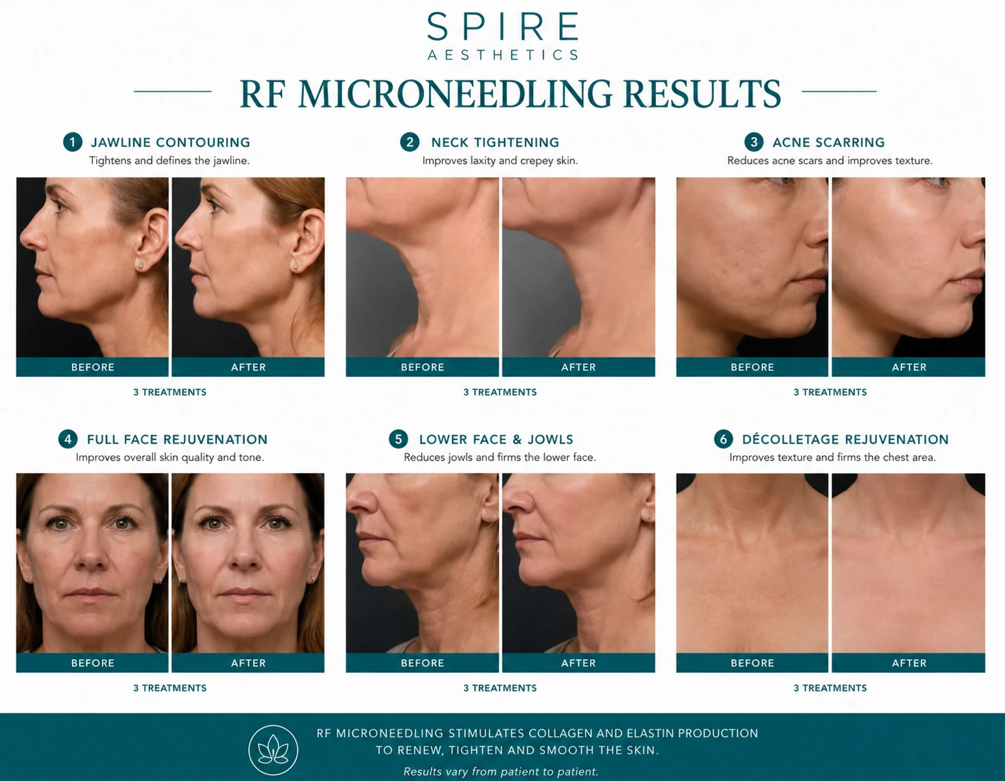 RF Microneedling Skin tightening Great Missenden results
