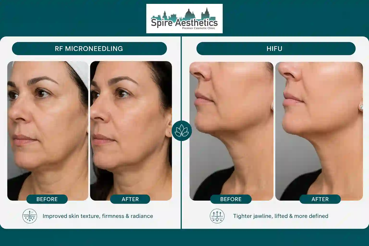 Can RF Microneedling and HIFU Be Combined Great Missenden?