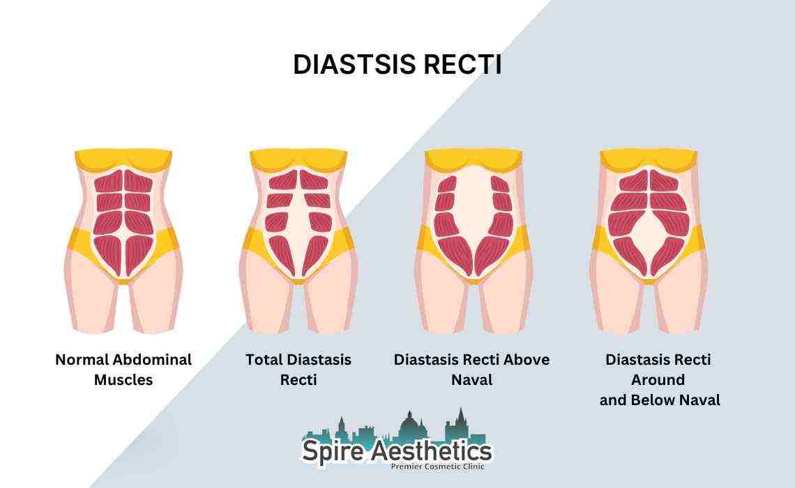 Is Non-Surgical Diastasis Recti Treatment Right for You? Common Concerns Answered Great Missenden